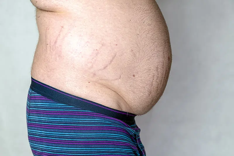 A man suffering from stretch marks on his stomach area