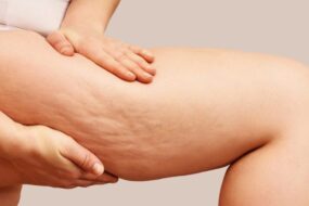 Loose skin on the legs after rapid weight loss.